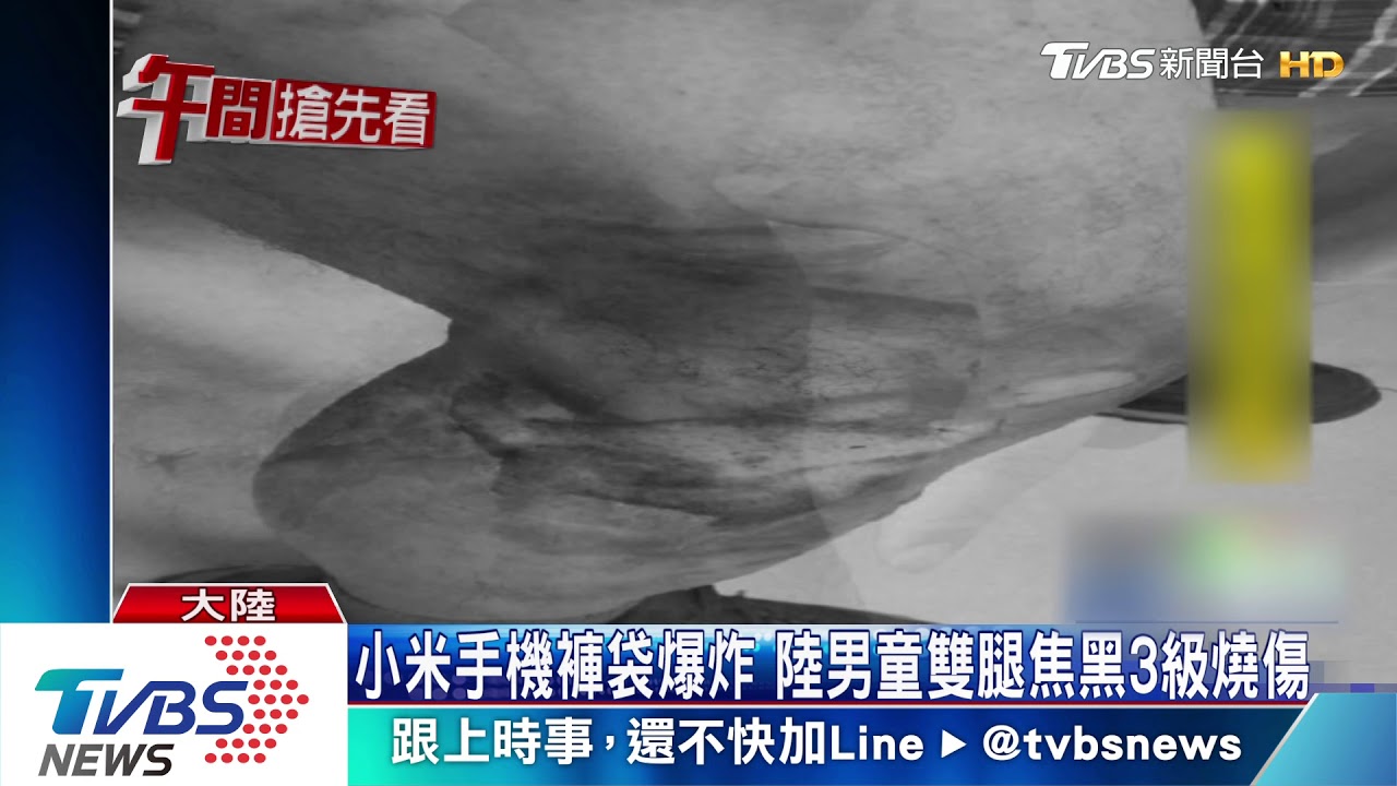 燒穿口袋!小米手機爆炸 陸男雙腿3級灼傷