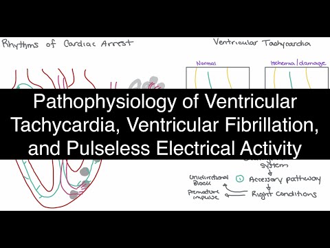 Pathophysiology of Ventricular Tachycardia (VT), Ventricular Fibrillation (VF), and PEA