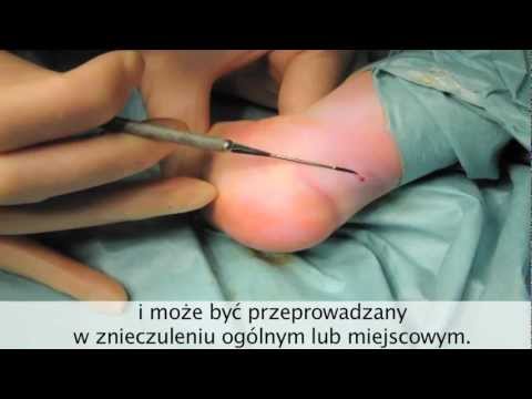 Skok na kości palucha Varus koślawe zniekształcenie