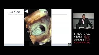 Imaging the Intra-Atrial septum – Prof Gregory Scalia