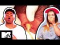 An Amazing Pus Rocket Erupts From A Man’s Massive Neck Boil | What The Yuck?! Ep #2