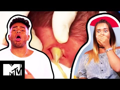 An Amazing Pus Rocket Erupts From A Man’s Massive Neck Boil | What The Yuck?! Ep #2