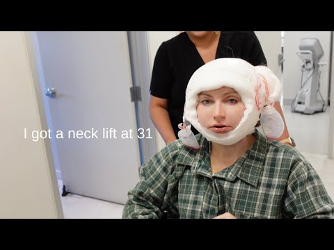 PLASTIC SURGEY - I got a neck lift at 31... before & after