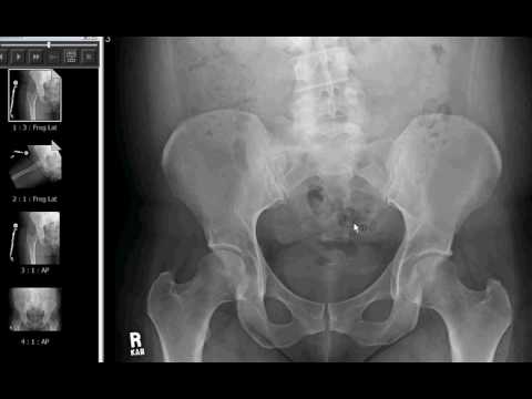 Dolore parte inferiore Terapia magnetica per immagini osteocondrosi