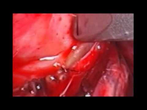 Thoracoscopic Esophagectomy For Cancer Of  Esophagus