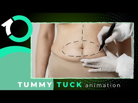 Extended Abdominoplasty (Tummy Tuck) - Surgical Procedure - One Clinic Patient Review Video