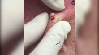 Popping huge blackheads and Giant Pimples - Best Pimple Popping Videos #118