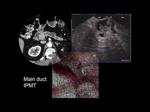 Imaging of Pancreatic Cystic Lesions