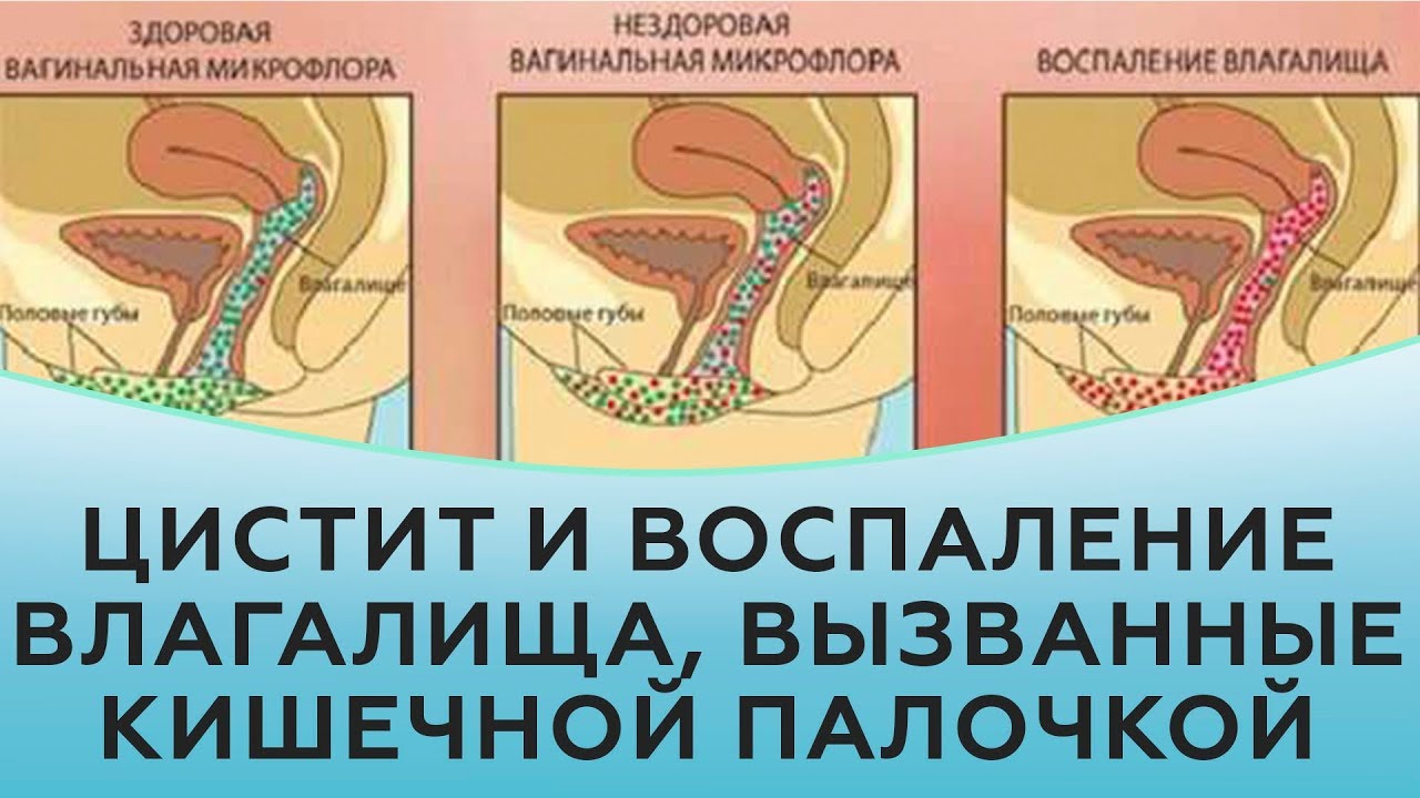 Цистит и воспаление влагалища, вызванные кишечной палочкой