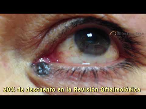 Lesiones Palpebrales