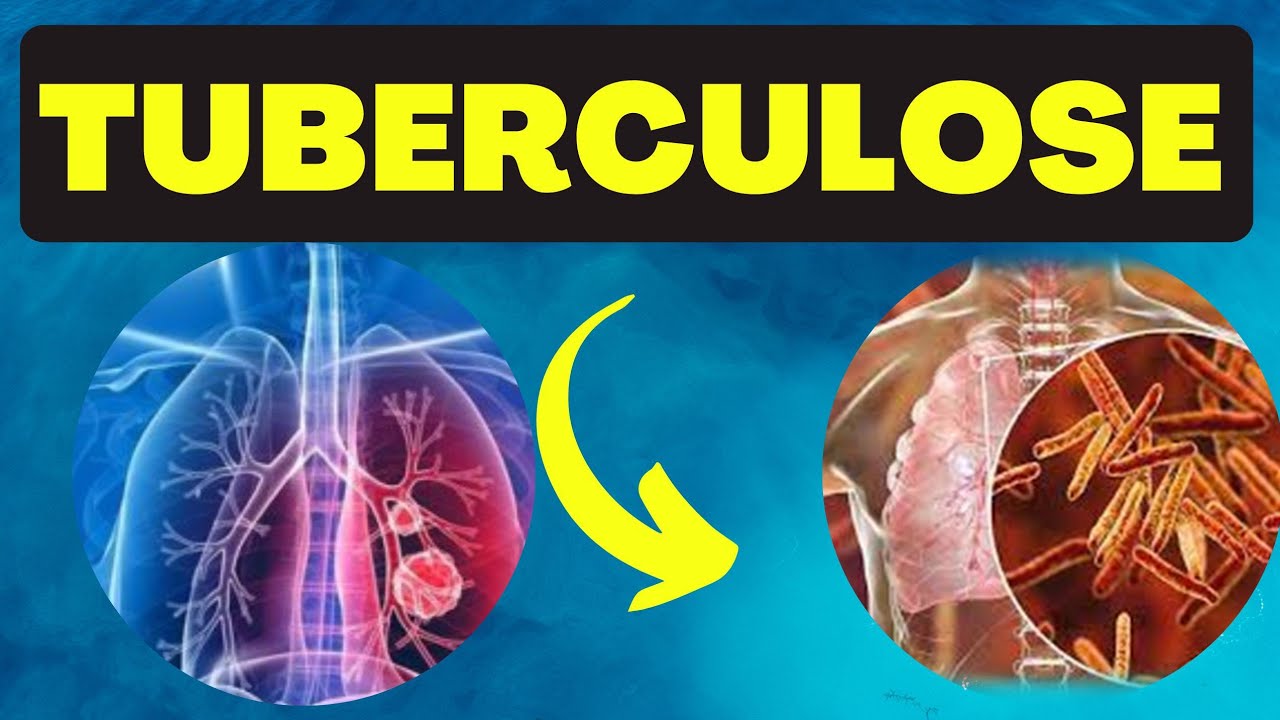 TUBERCULOSE  -  Definição, agente etiológico, transmissão,  manifestação clínica e diagnóstico.