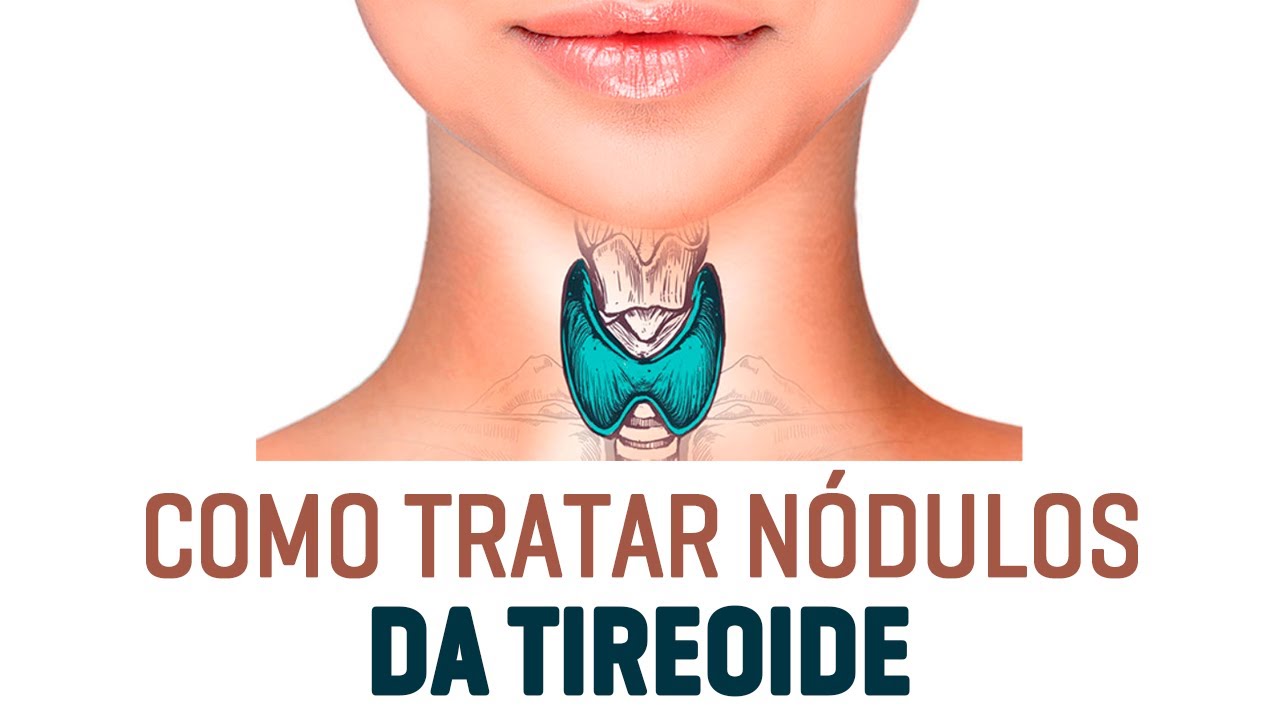 Como Tratar Nódulos Da Tireoide [Dr. Rogério Leite]