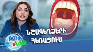 Բուժ ինֆո / Խորհուրդ մասնագետից / Նշագեղձերի հեռացում / Buj Info
