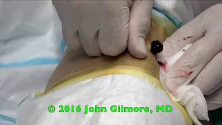 Grape Jelly Cyst?  Trypophobia Cysts