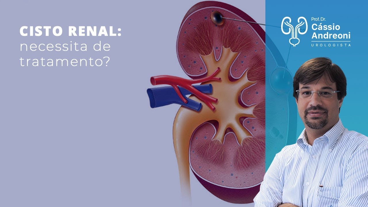 Cisto renal: necessita de tratamento | Dr. Cassio Andreoni CRM 78.546