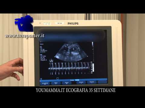 Mal di schiena sul lato sinistro Ginocchio dieta osteocondrosi congiunta