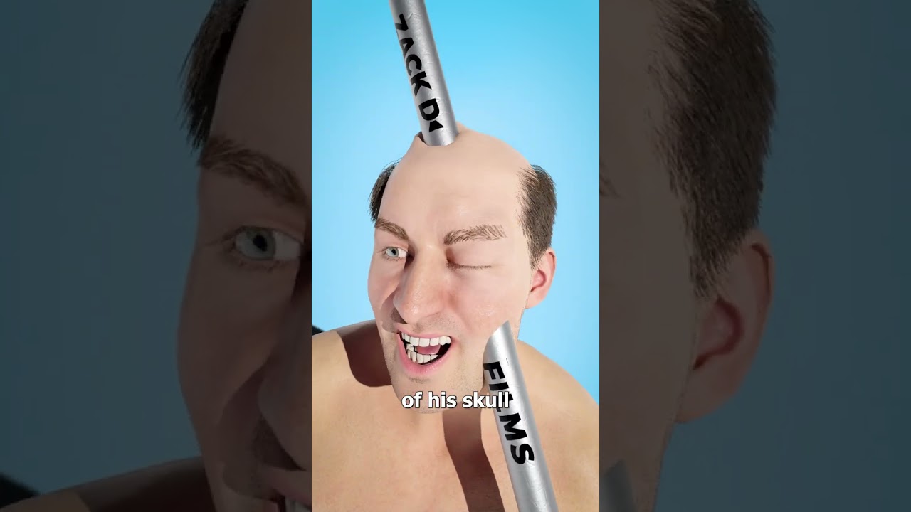 Iron Rod Through The Head 😨