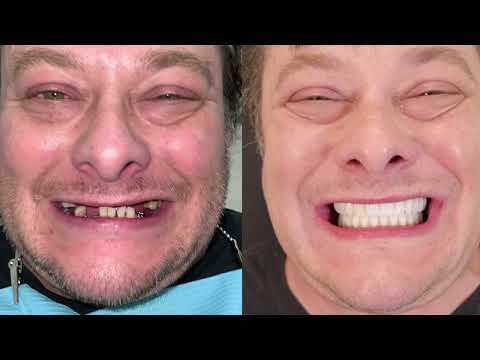 Edward Furlong: New Smile in just 24 Hours!