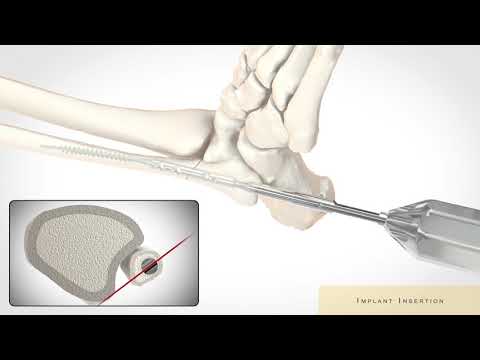 FlexThread Fibula Pin Surgical Technique