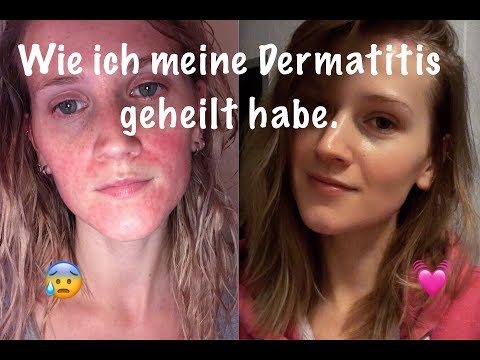 Ob den Essig das Ekzem behandelt Dass die Impfung von der Schuppenflechte gibt