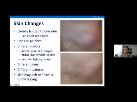 Localized Scleroderma Overview
