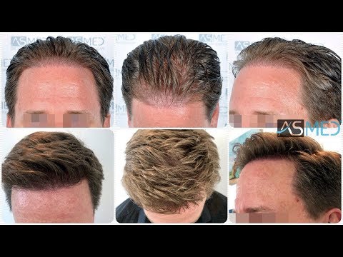 Manual FUE Hair Transplant Before & After, 2450 Grafts Result - ASMED - Dr. Koray Erdogan