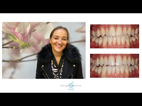 Leicester Glen Dental - Jessica's Smile Story