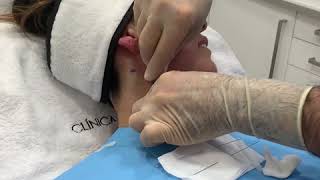 Hilos tensores en Clínica Benzaquén. Hilos tensores Málaga y Marbella, Silhouette Soft.