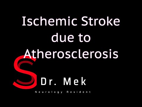 Strike Stroke with Dr. Mekdes: Ischemic stroke due to atherosclerosis (E6)