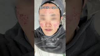 흉터 치료 큐어젯 시술 과정