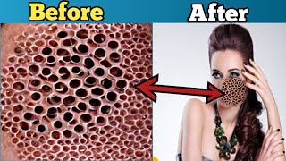 How to remove "Pimples", "Acne" and "Black spot" from Face At home 😮😮