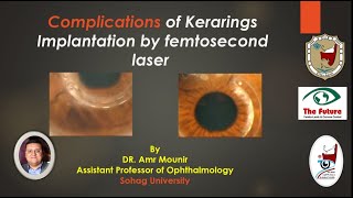Kerarings Complications