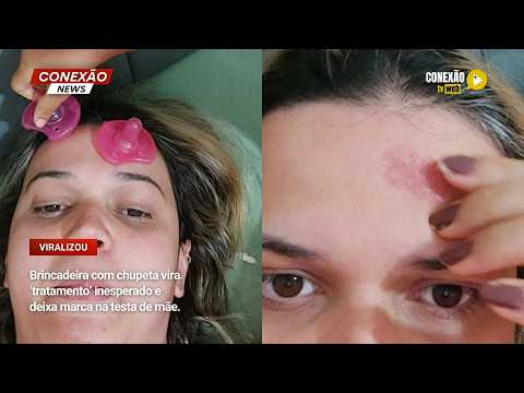 Vídeo: Brincadeira com chupeta vira ‘tratamento’ inesperado e deixa marca na testa de mãe.
