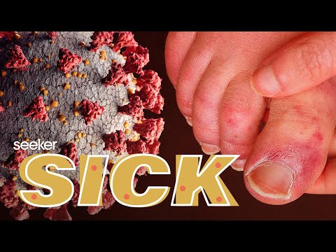 奇怪的症狀。為什麼COVID-19會影響皮膚、嗅覺等等 (Strange Symptoms: Why COVID-19 Affects the Skin, Sense of Smell, and More)