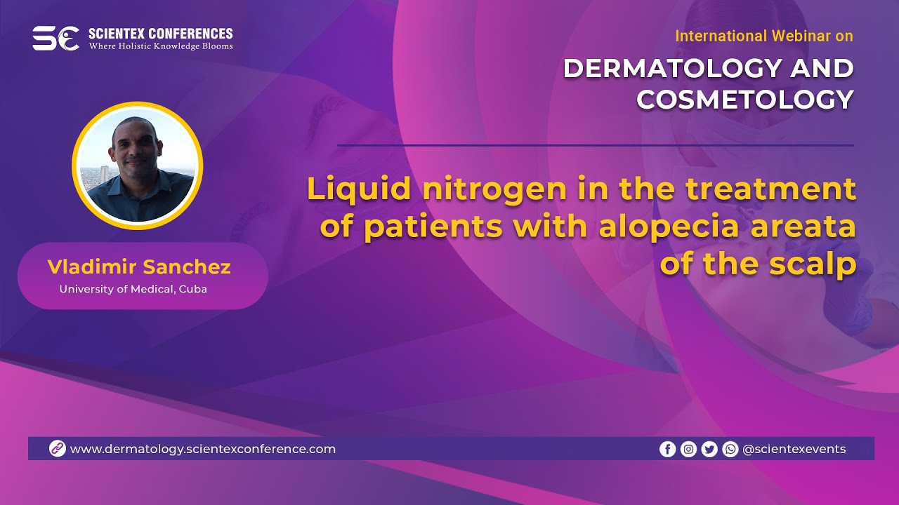 Liquid nitrogen in the treatment of patients with alopecia areata of the scalp