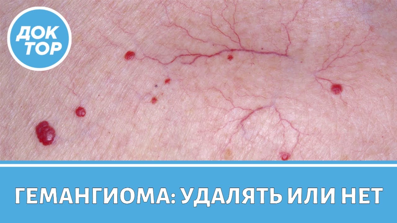 Главные правила профилактики гемангиом