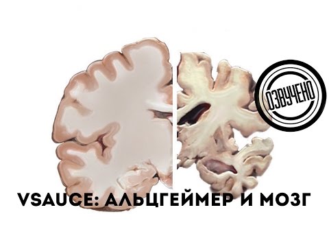 Vsauce: мозг и болезнь Альцгеймера