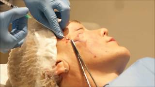 Face Cog Thread Lift