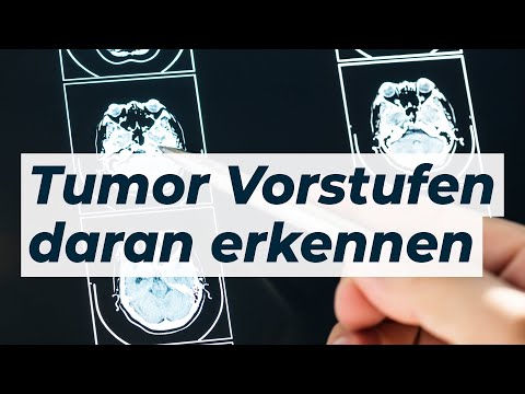 Präkanzerose - ein böses Vorzeichen! Dr. Eduard Karsten klärt auf