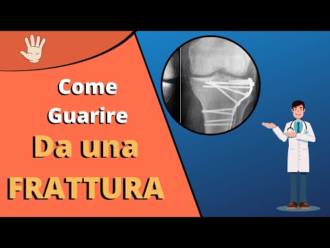 Come guarire velocemente da una frattura