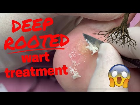 Hpv lip wart treatment