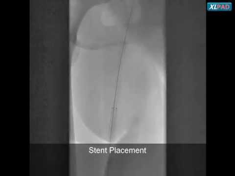 Viance, PTA, and Stenting of Right SFA CTO