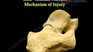 Calcaneal IntraArticular Fractures Essex Lopresti - Everything You Need To Know - Dr. Nabil Ebraheim