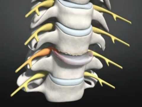 Operation Zervikale Bandscheibenprothese-Halswirbelsäule