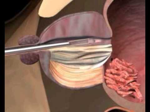 A causa della prostatite può essere mughetto Prostata 31 cc