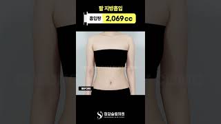 결혼 전 팔뚝살 고민이세요?