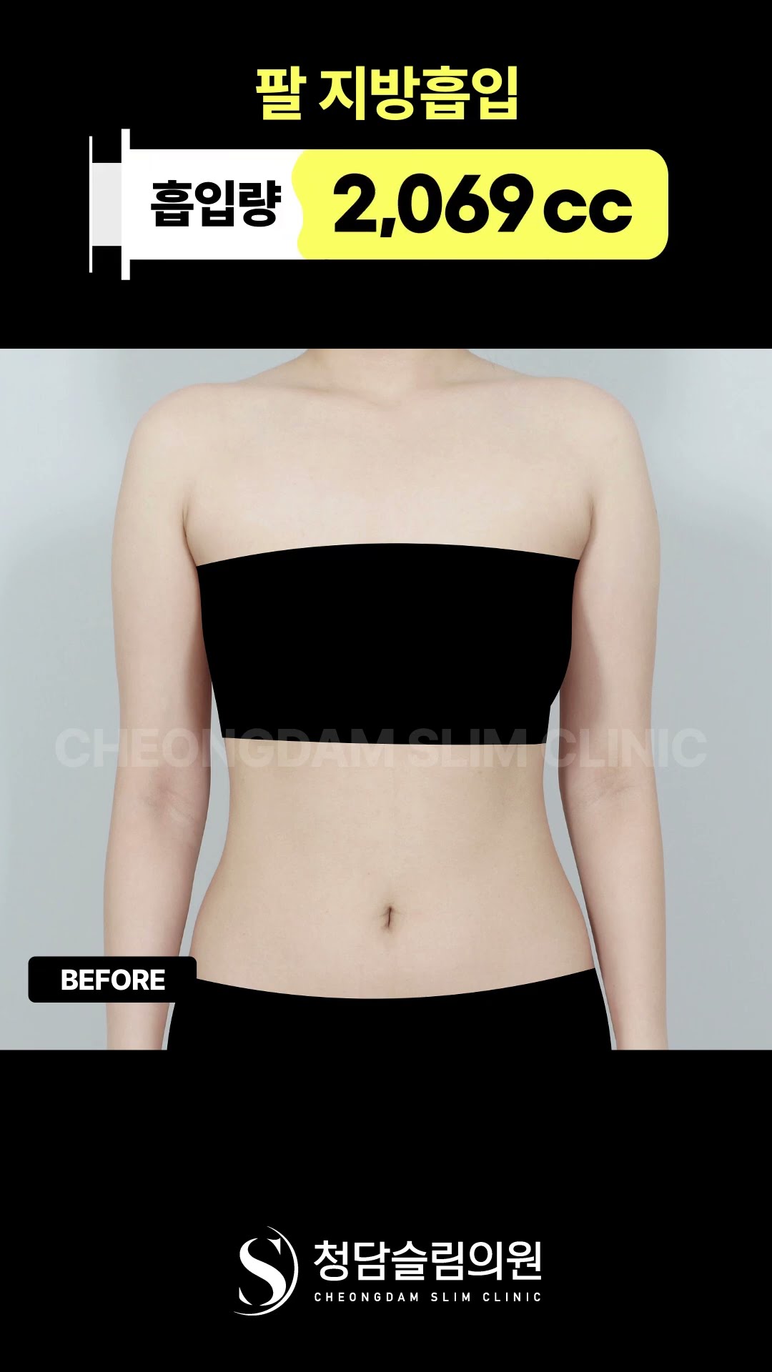 결혼 전 팔뚝살 고민이세요?