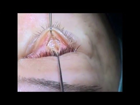 Maschere per occhi da appeso un secolo Fili dargento per sollevamento di faccia