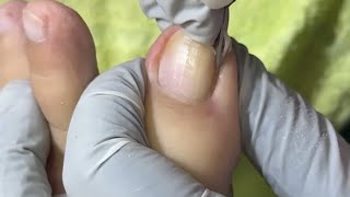 Ep_8656 Ingrown toenail removal 👣 เล็บแบบนี้..เวลาตัดต้องระวัง  🙂 (clip from Thailand)
