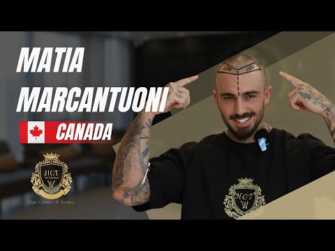 Matia's Hair Transplant Journey in Turkey: Amazing Transformation!